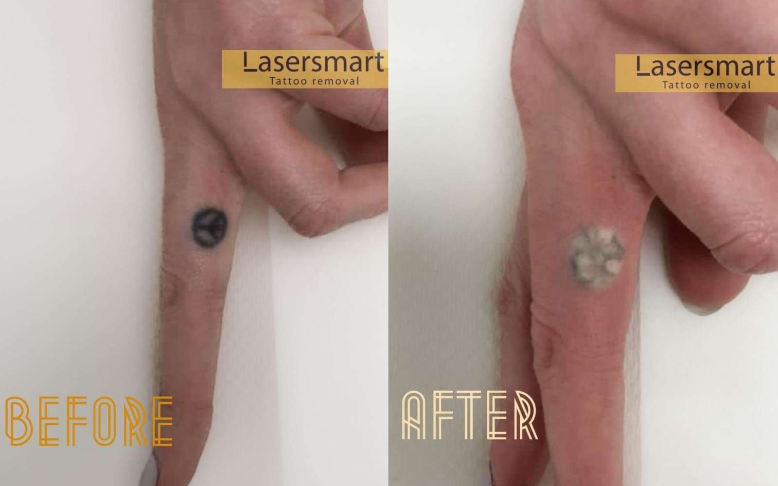 Peace symbol tattoo removal results