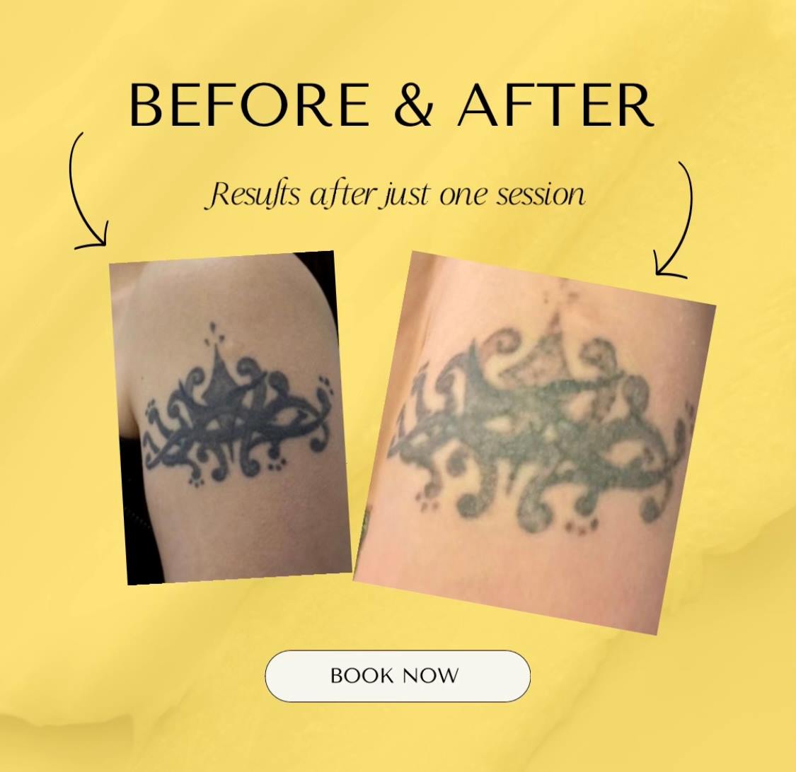 Before and after results from one session of laser tattoo removal