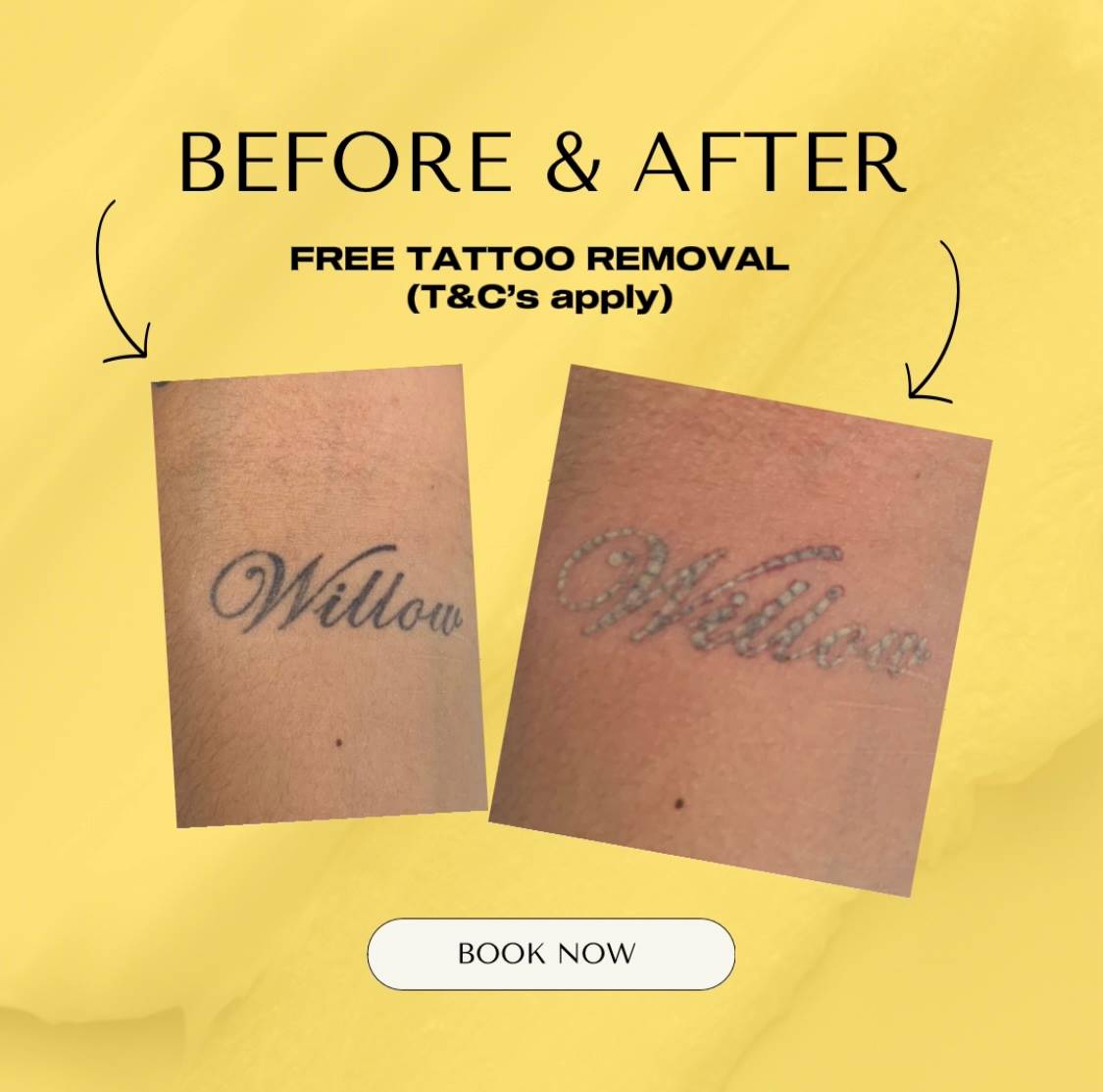 Results from free laser tattoo removal session at Lasersmart