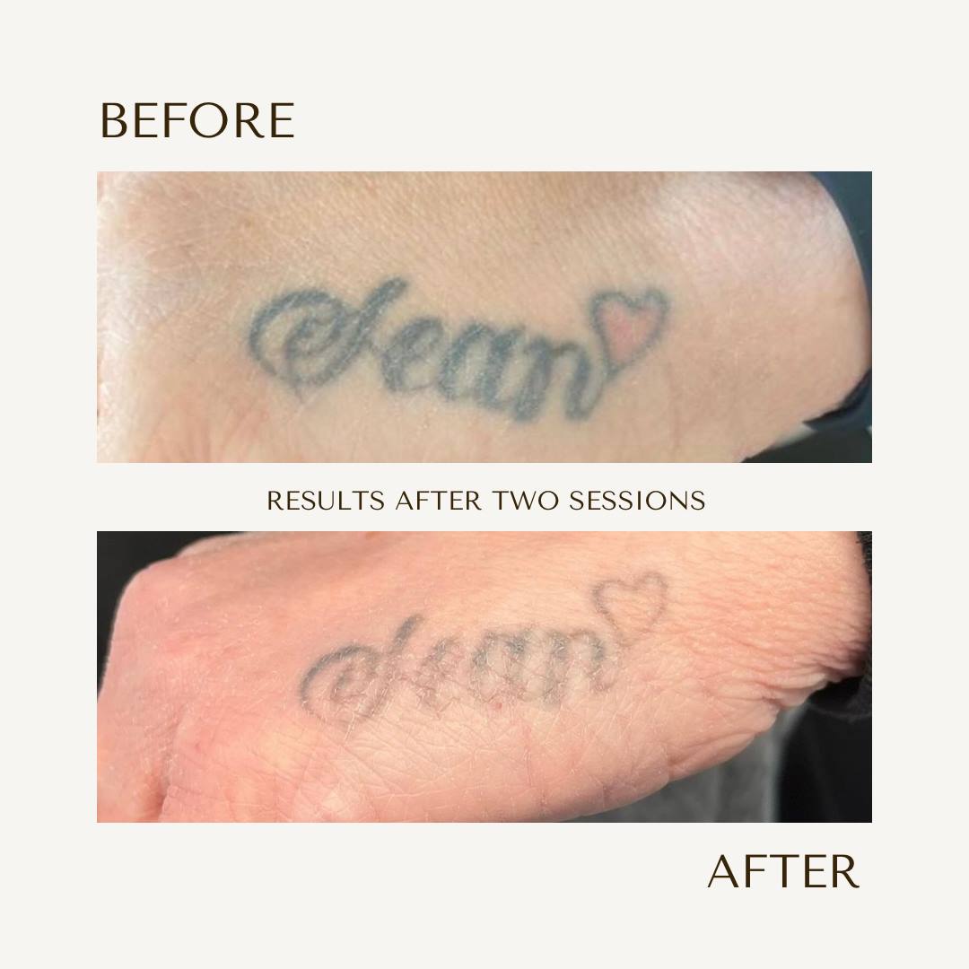Name tattoo removal results after 2 sessions