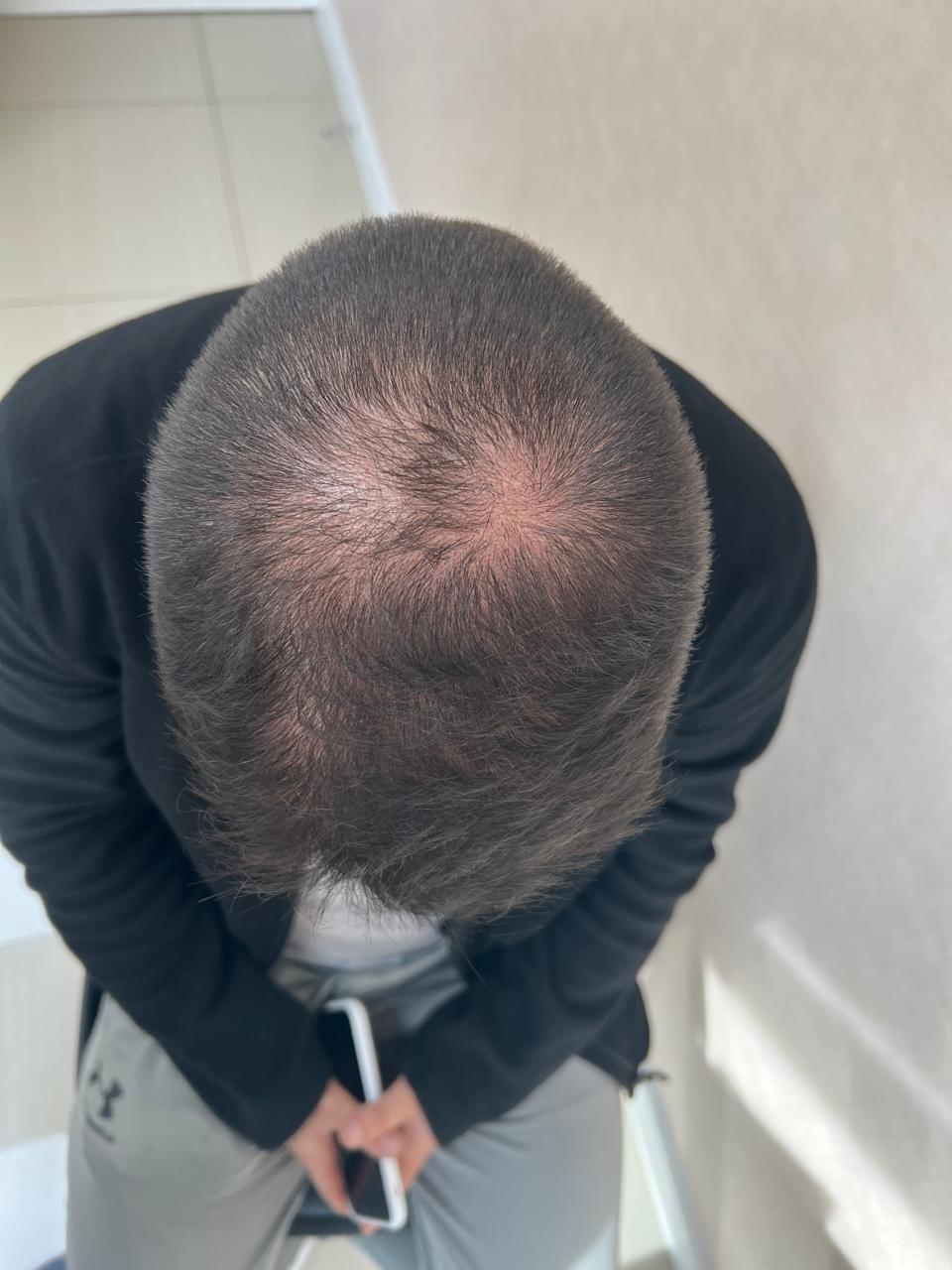 Antes del tratamiento