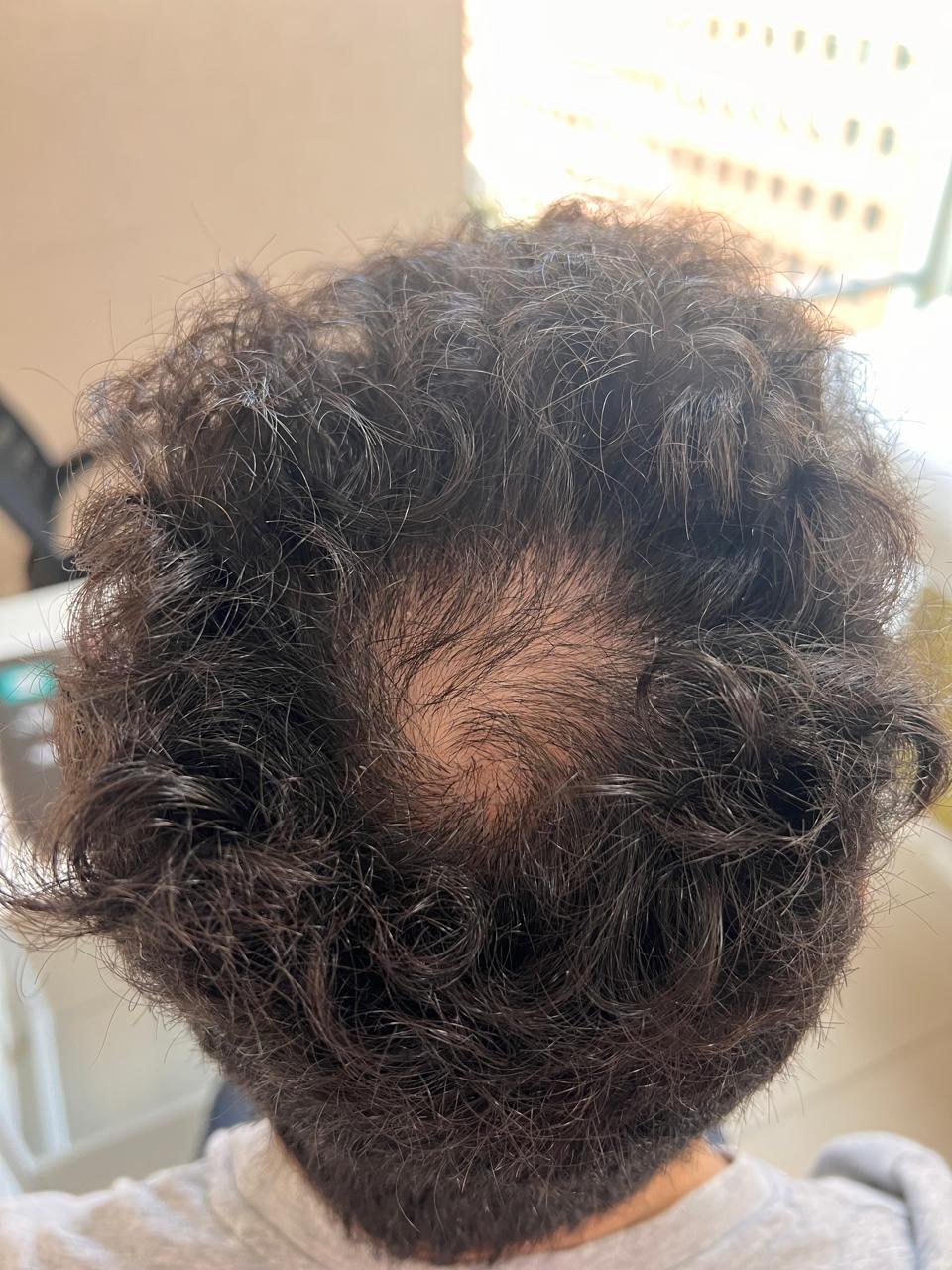 Antes del tratamiento