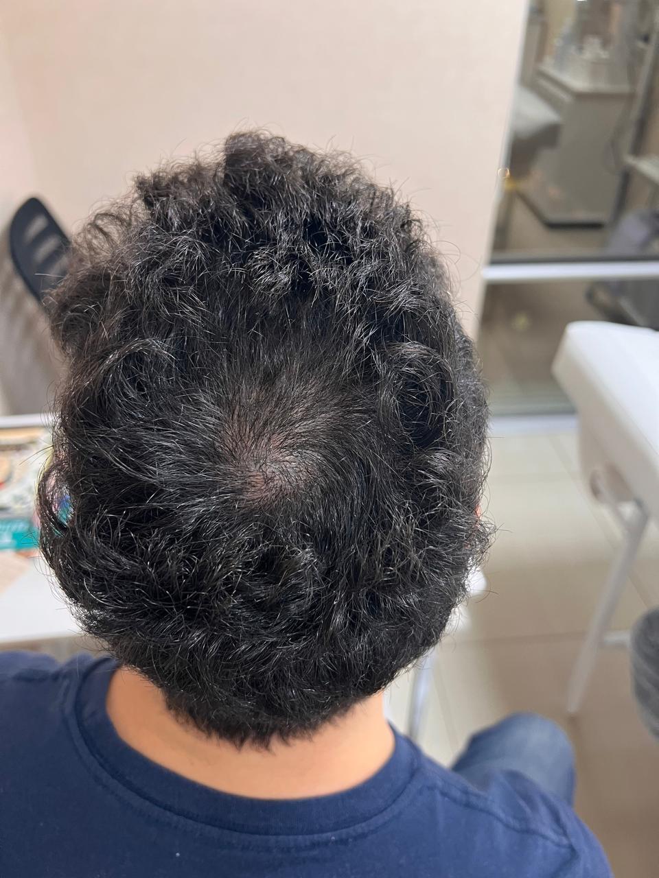 Después del tratamiento