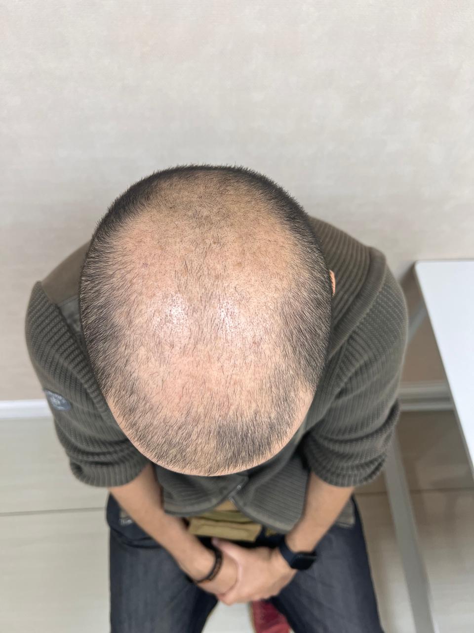 Antes del tratamiento