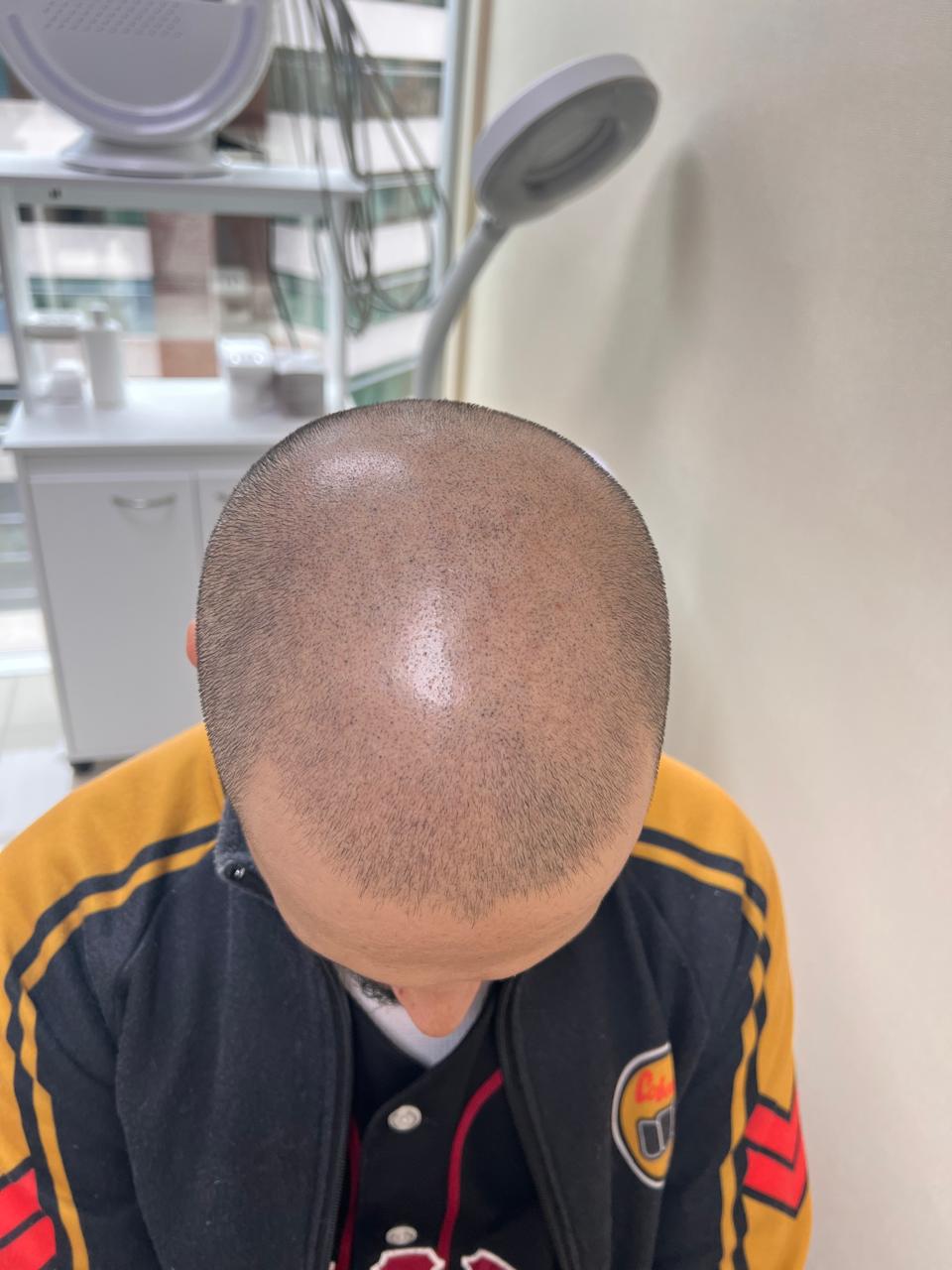 Después del tratamiento