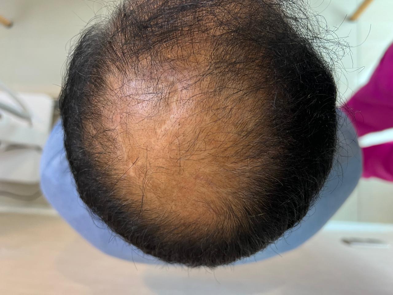 Antes del tratamiento