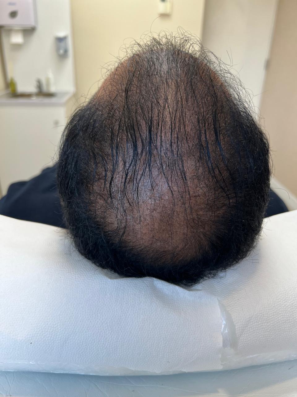 Después del tratamiento