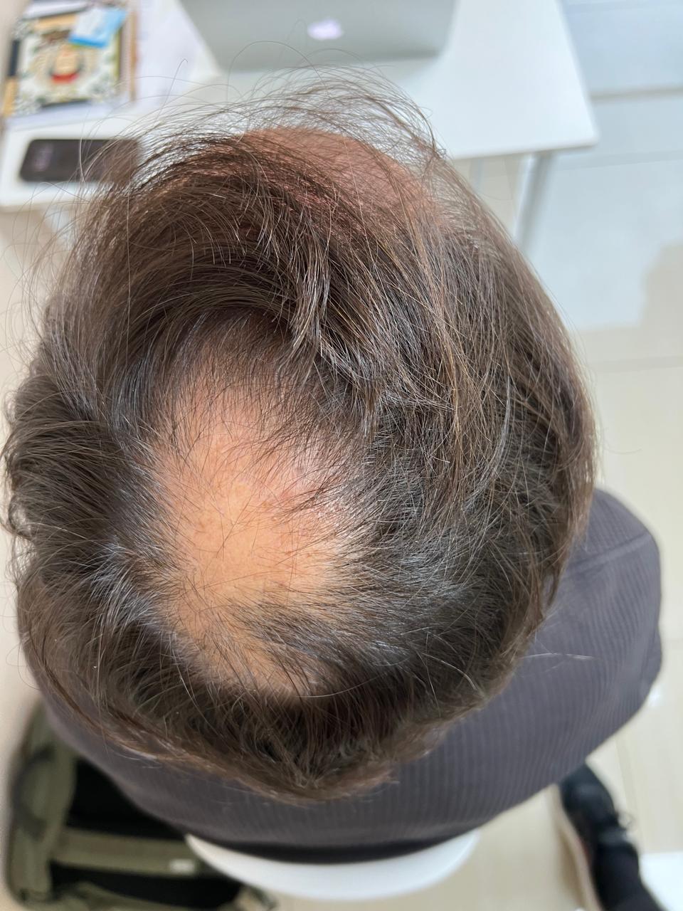 Antes del tratamiento