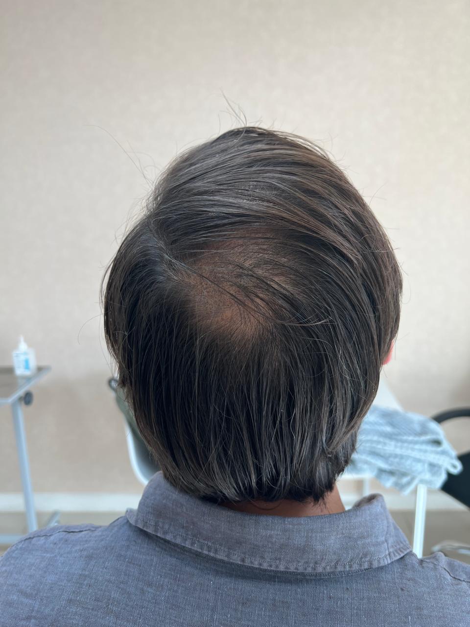 Después del tratamiento