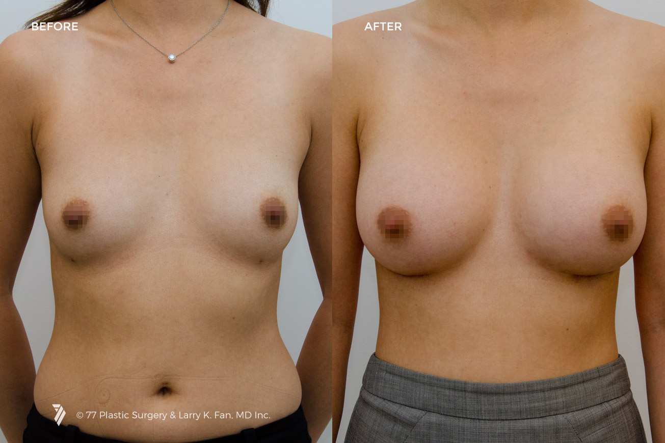 Case 22002 - Before/After 1
