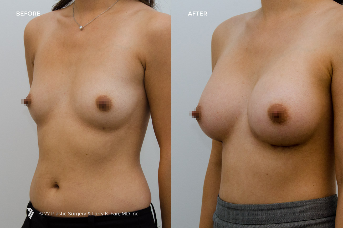 Case 22002 - Before/After 2
