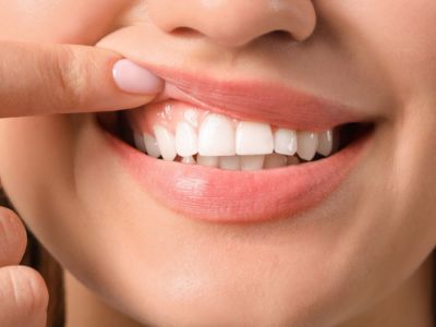 لثة صحية بعد العلاج