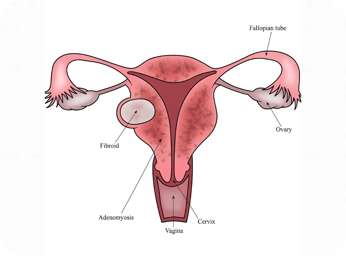 adenomyosis adenomyosis