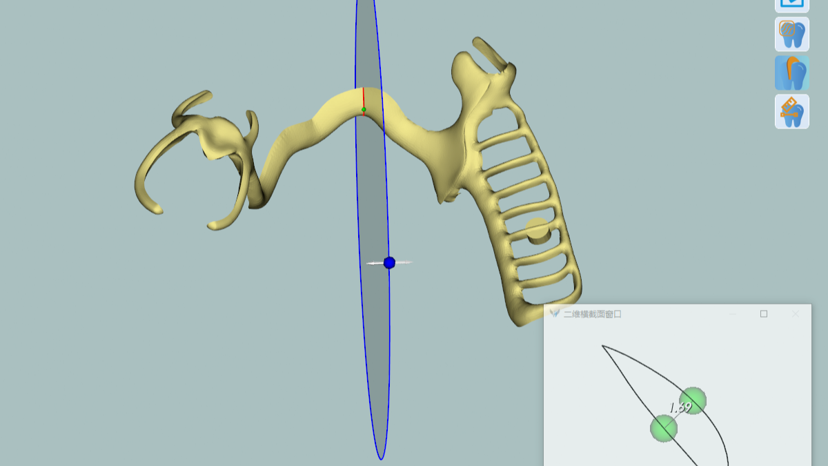 printed titanium partial
