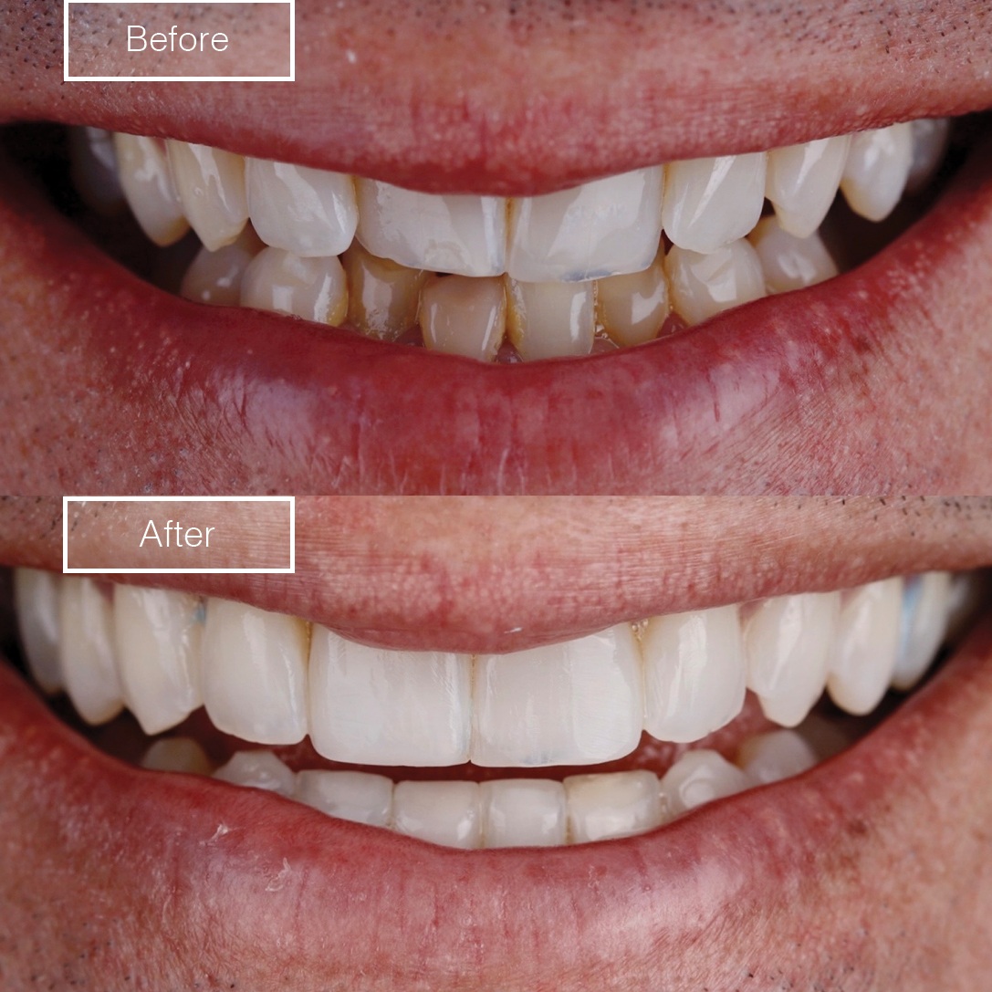 Smile 5