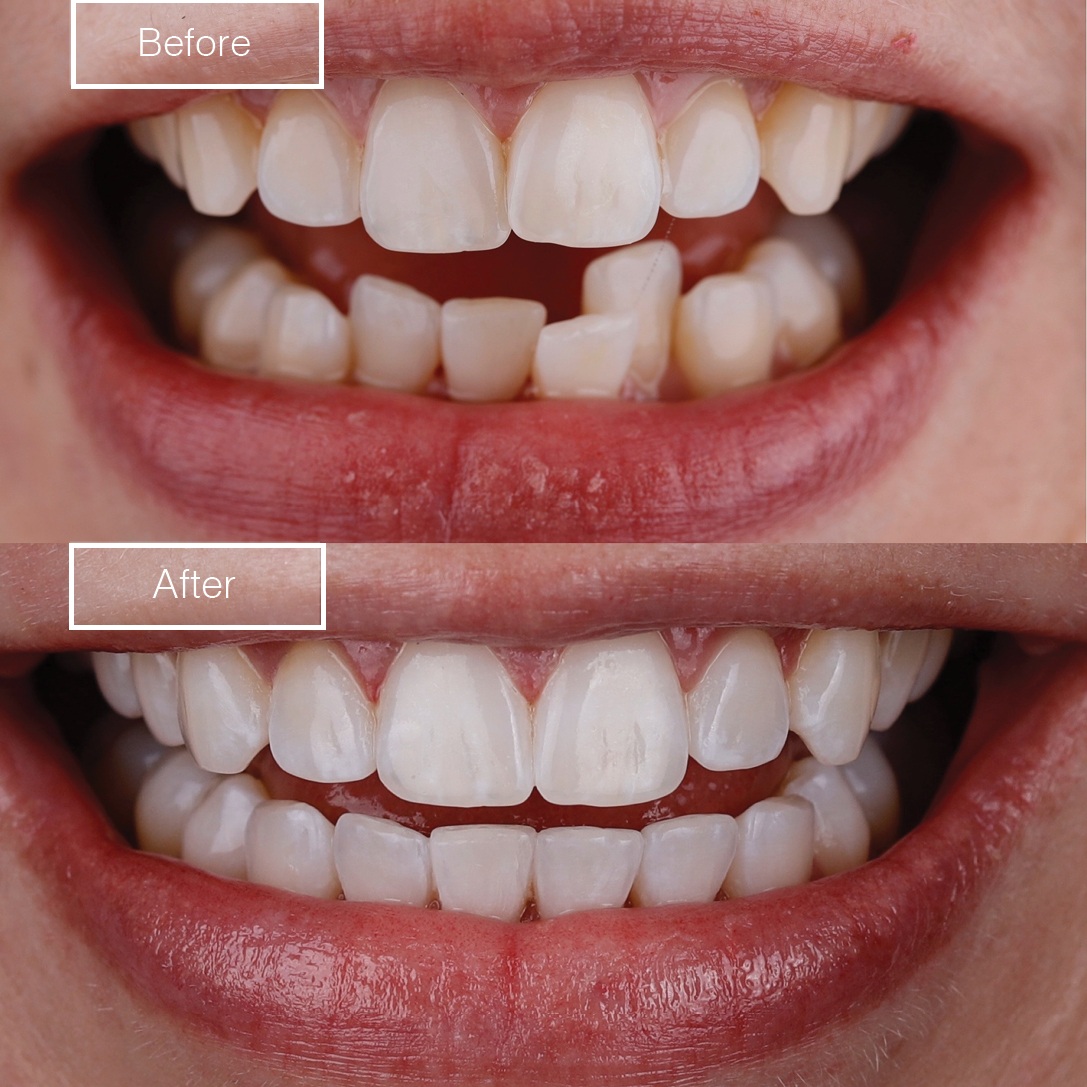 Smile 2