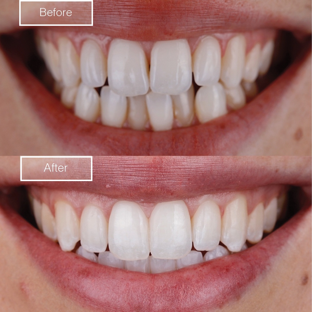 Smile 4