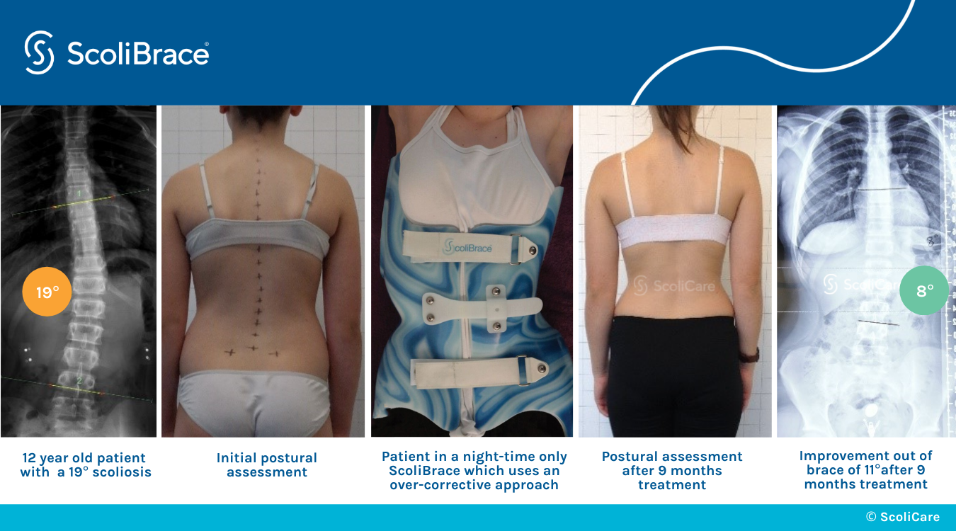 Types of ScoliBrace - Scoliosis Clinic UK - Treating Scoliosis without  surgery