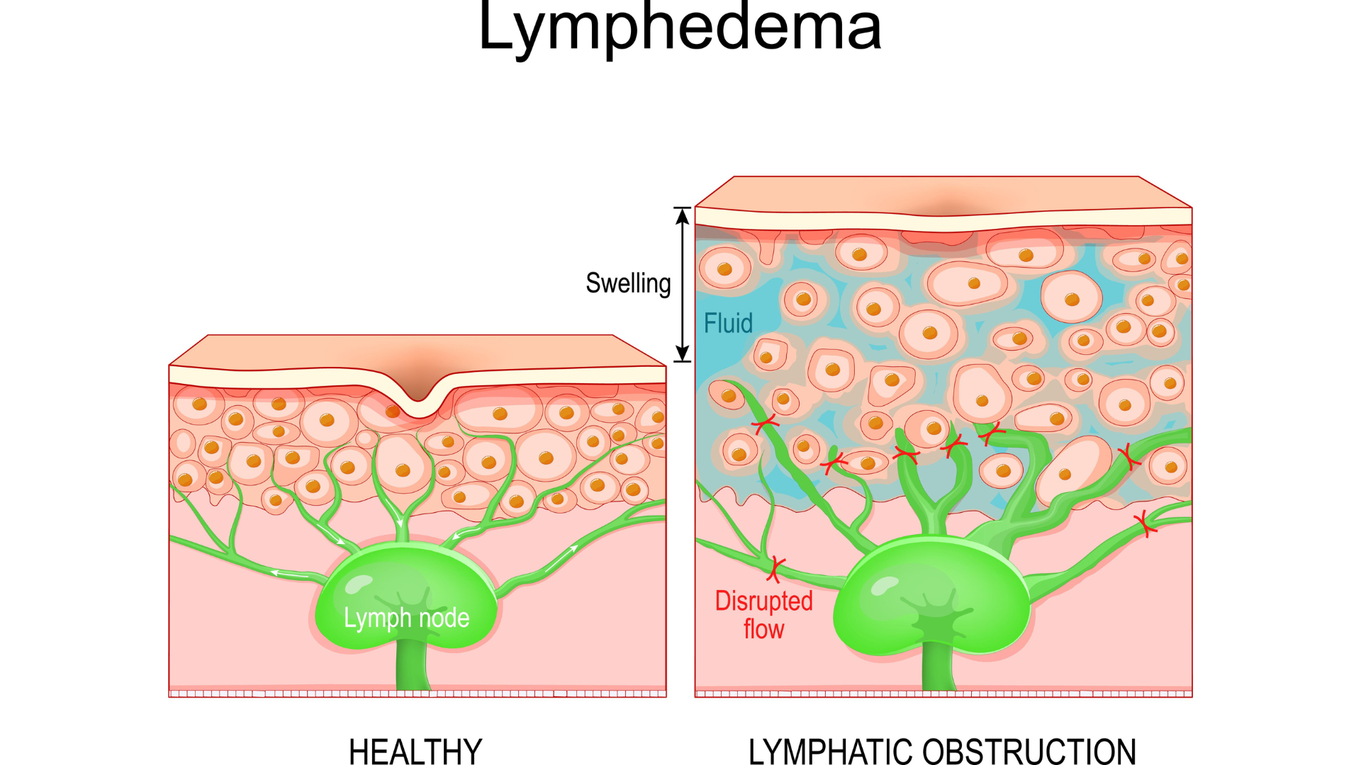 What’s Lymphedema