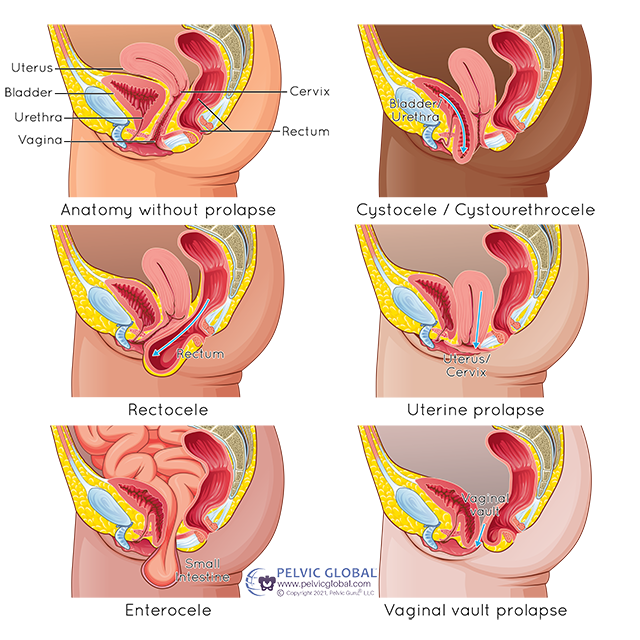 Pelvic Organ Prolapse 