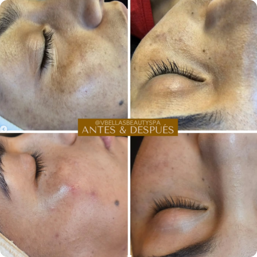 Comparación antes y después de un tratamiento facial en spa. Comparación antes y después de un tratamiento facial en spa.