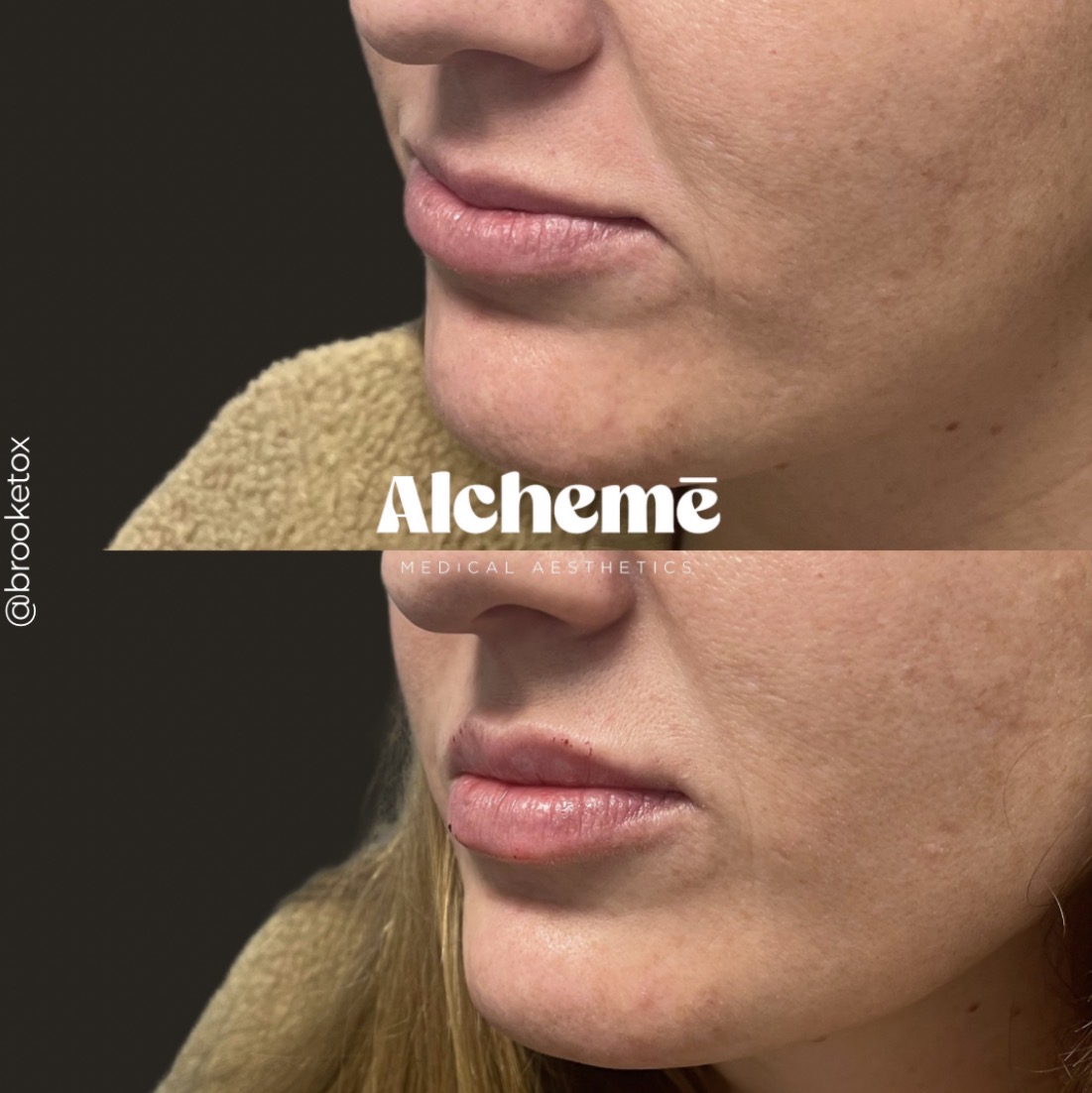Dermal filler result 18