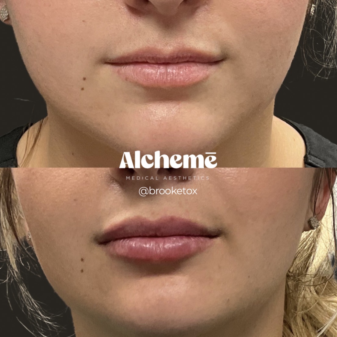 Dermal filler result 23