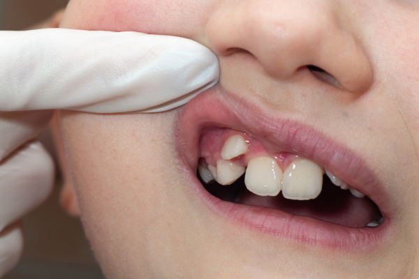 Misaligned Teeth or Malocclusion Misaligned Teeth or Malocclusion