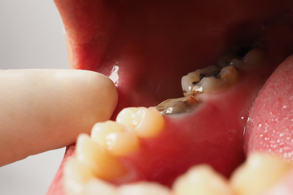 Diagram showing sugar interacting with bacteria to produce acid, leading to tooth decay Diagram showing sugar interacting with bacteria to produce acid, leading to tooth decay