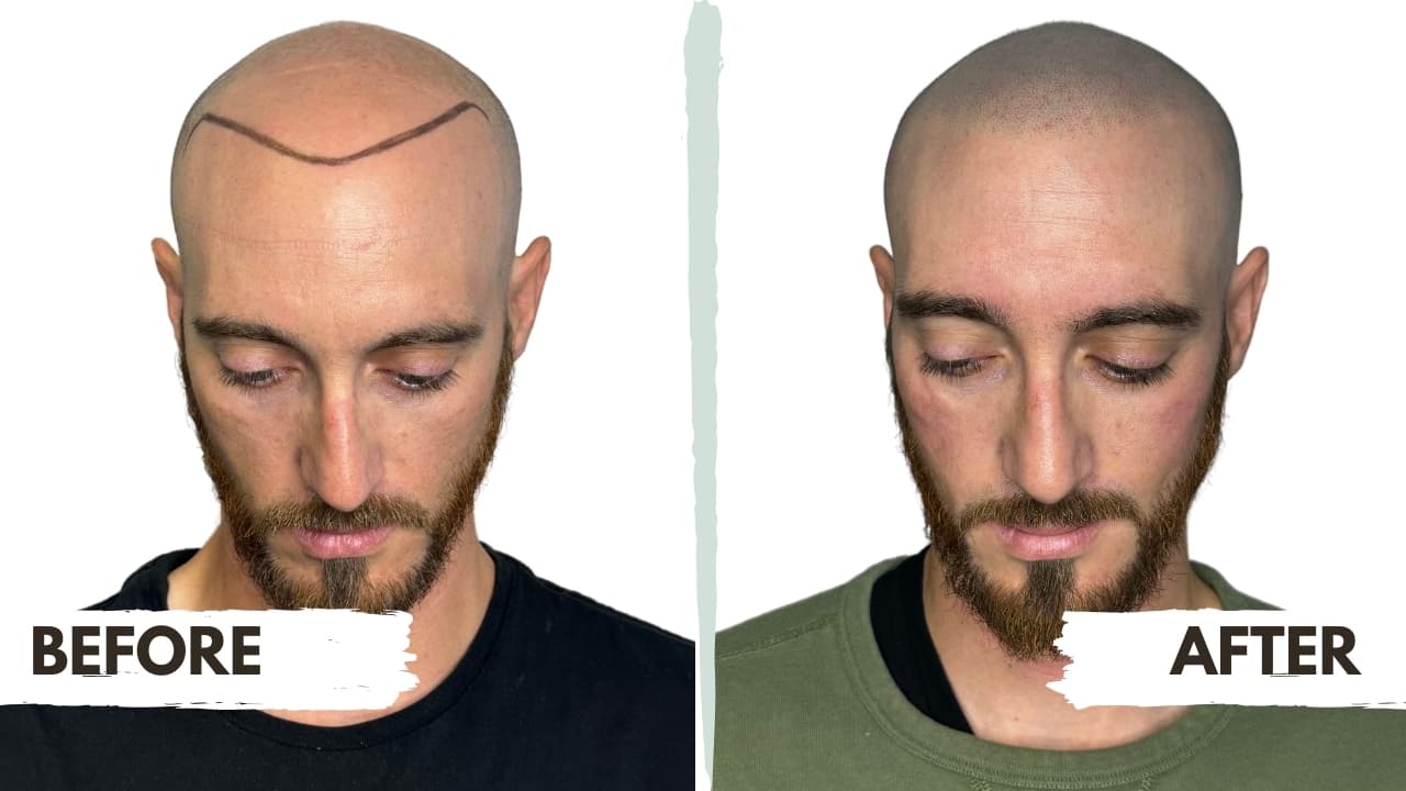 What is Scalp Micropigmentation? The Ultimate Guide