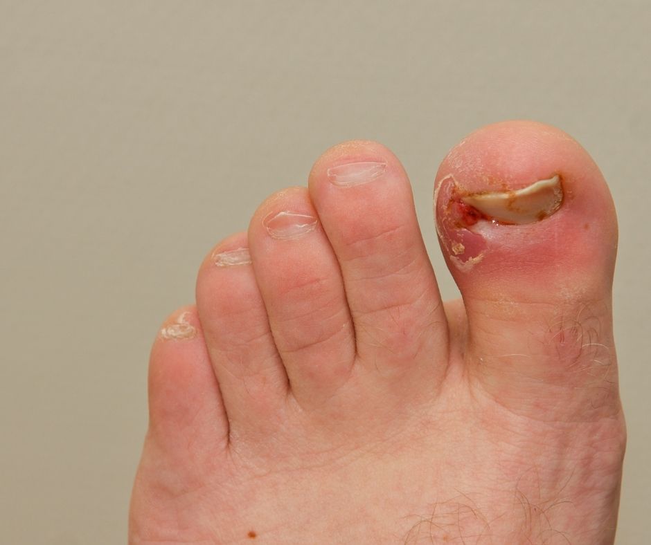 Ingrown Toenail