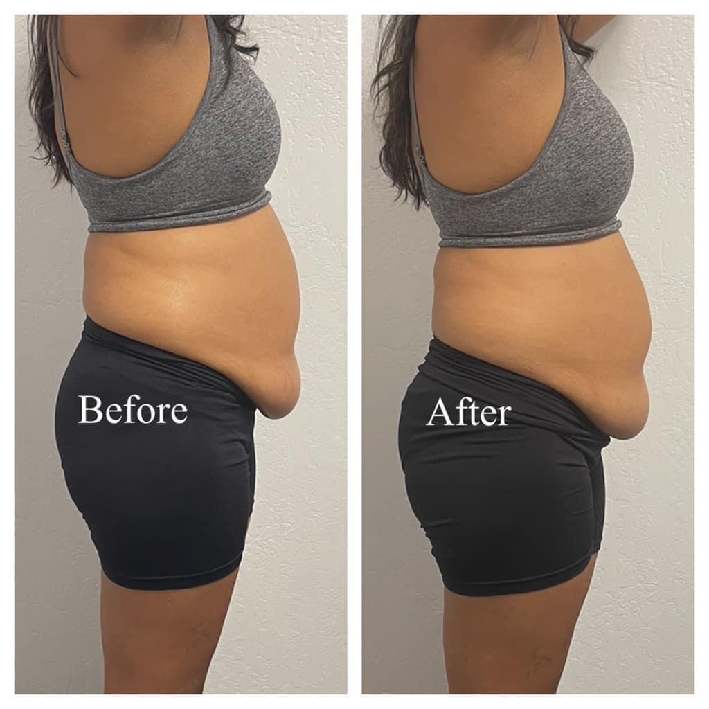 Body Sculpting Tuscaloosa, Tummy Tuck Northport