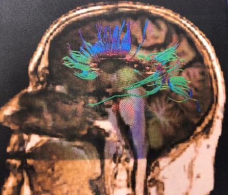 MRI DTI