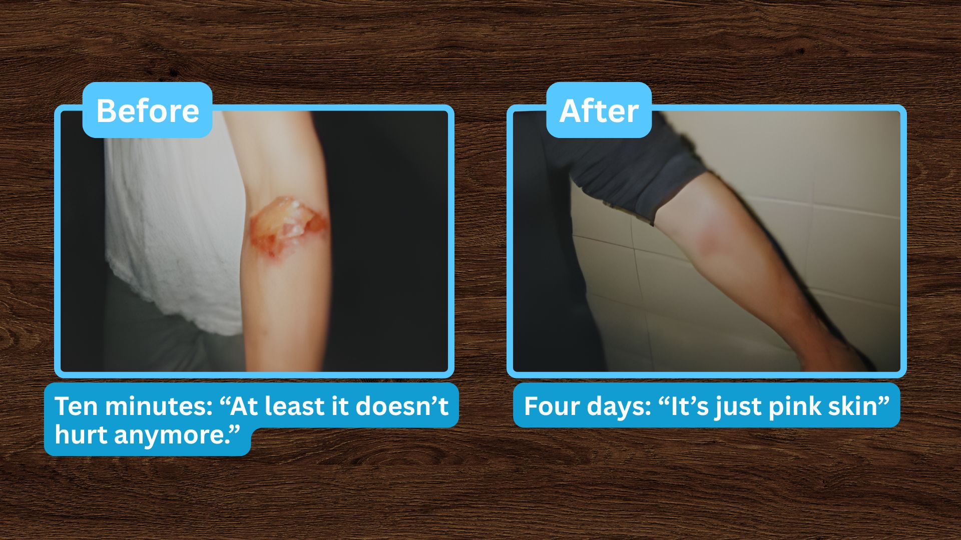 Acetylene Torch Burn