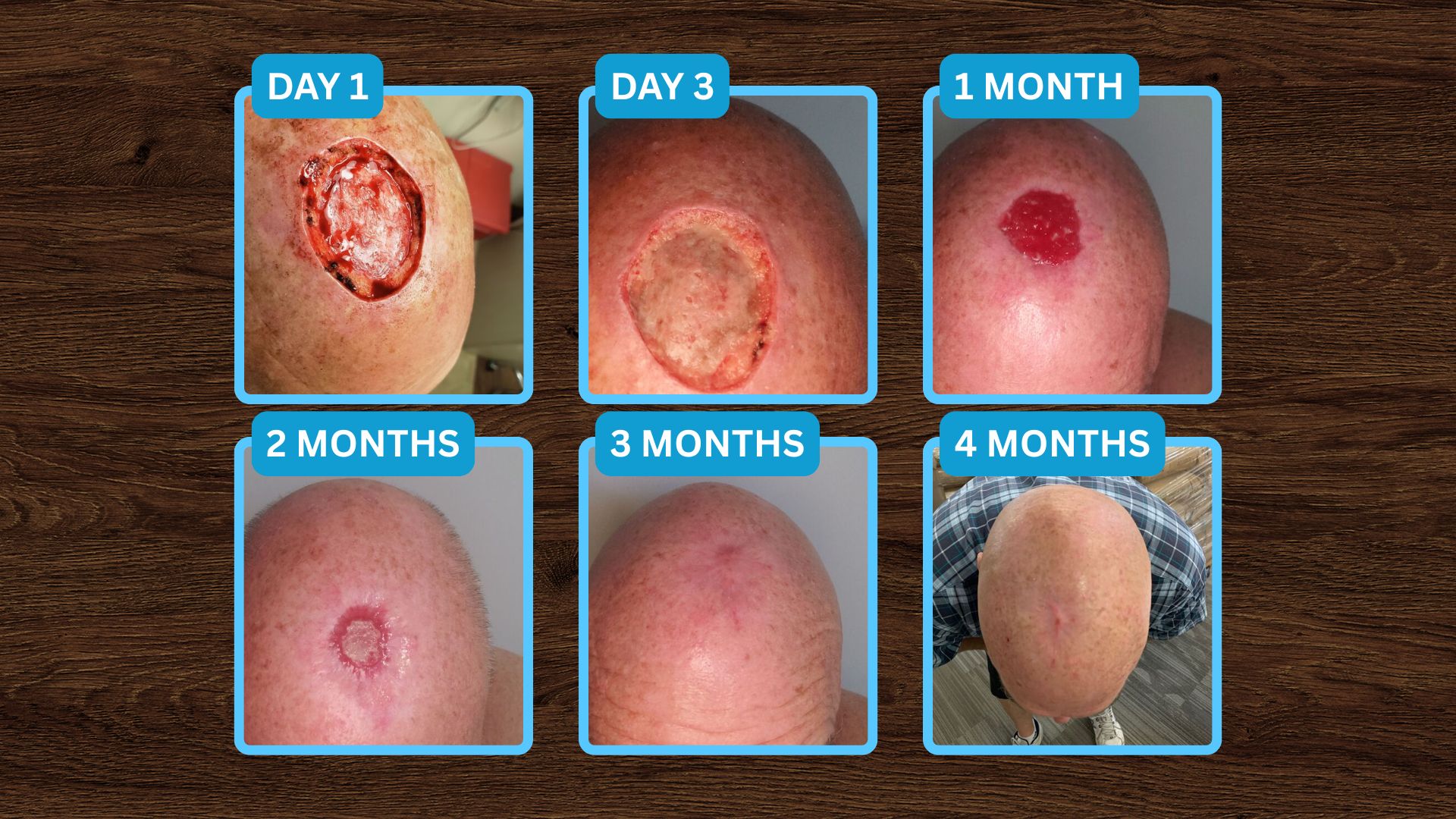 Head Wound after Cancerous Tumor was Removed