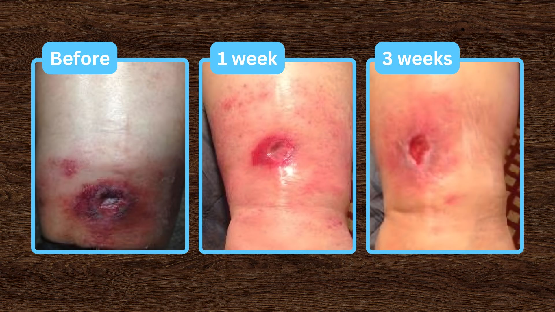 Broken Ankle with Infected Pins