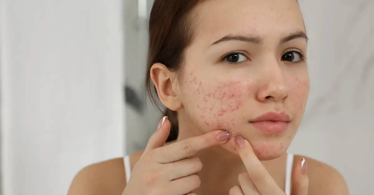 Close-up of a young woman with acne examining her face in the mirror, illustrating common skin concerns addressed in expert acne treatment options