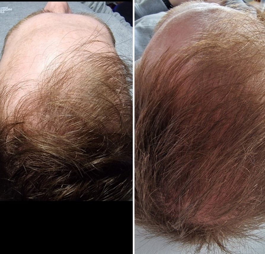 Hair Restoration Courses