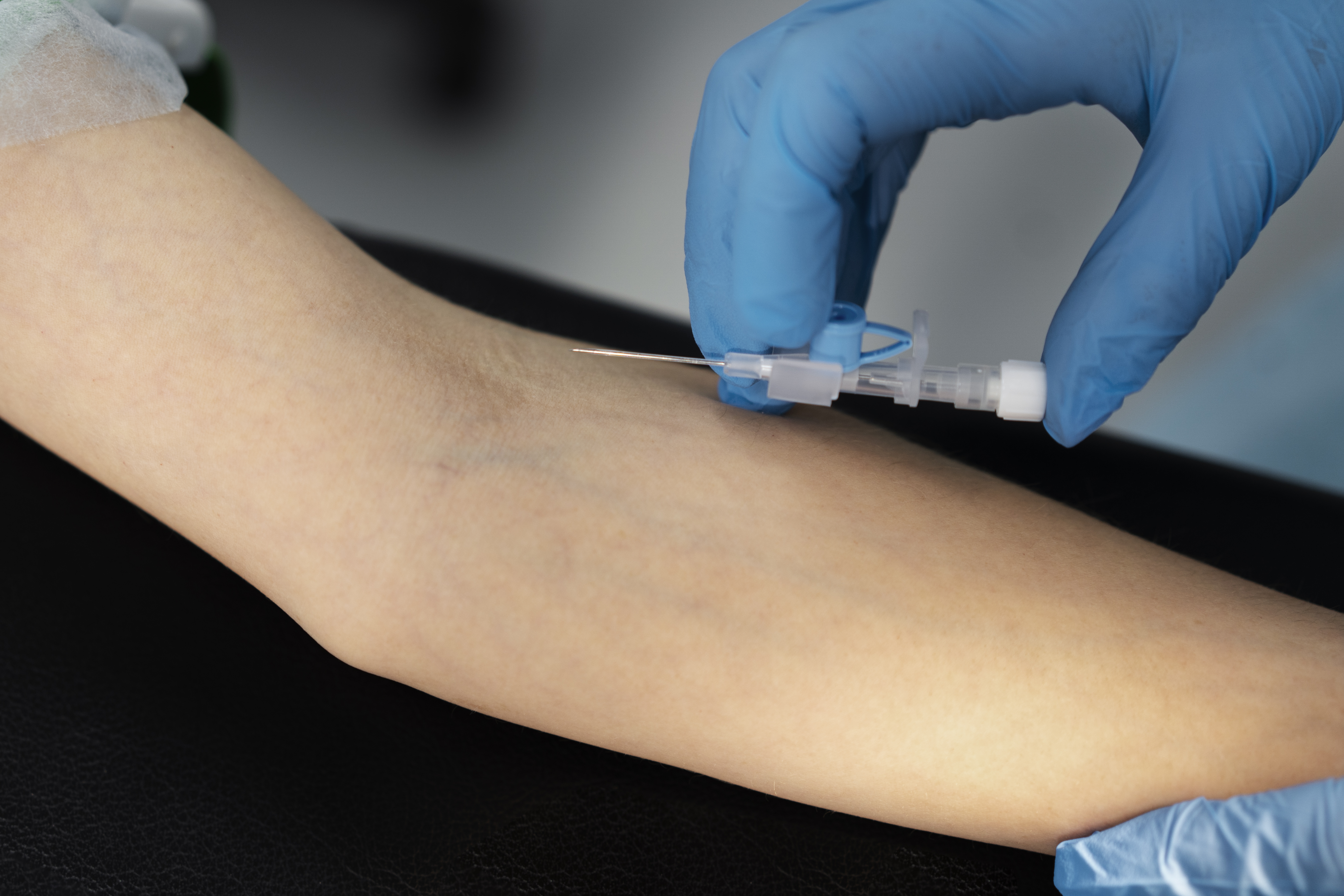 Sclerotherapy
