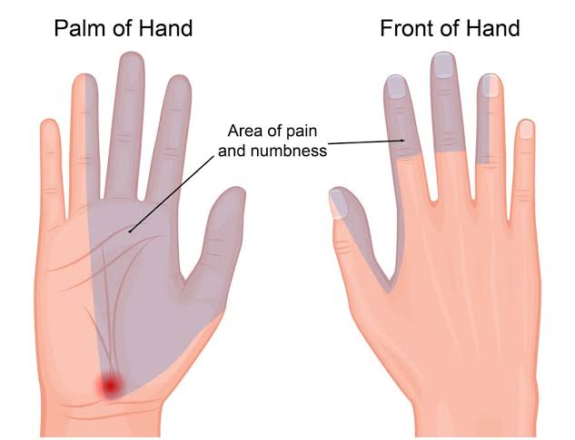 Ilustrasi perubatan Carpal Tunnel Syndrome menunjukkan tekanan pada saraf median, kawasan kebas di tangan, dan perbandingan anatomi normal dan terjejas pada pergelangan tangan Ilustrasi perubatan Carpal Tunnel Syndrome menunjukkan tekanan pada saraf median, kawasan kebas di tangan, dan perbandingan anatomi normal dan terjejas pada pergelangan tangan