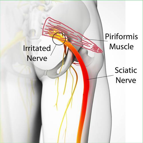 sciatica relief chiropractor stuart florida