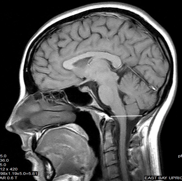 chiari chiari