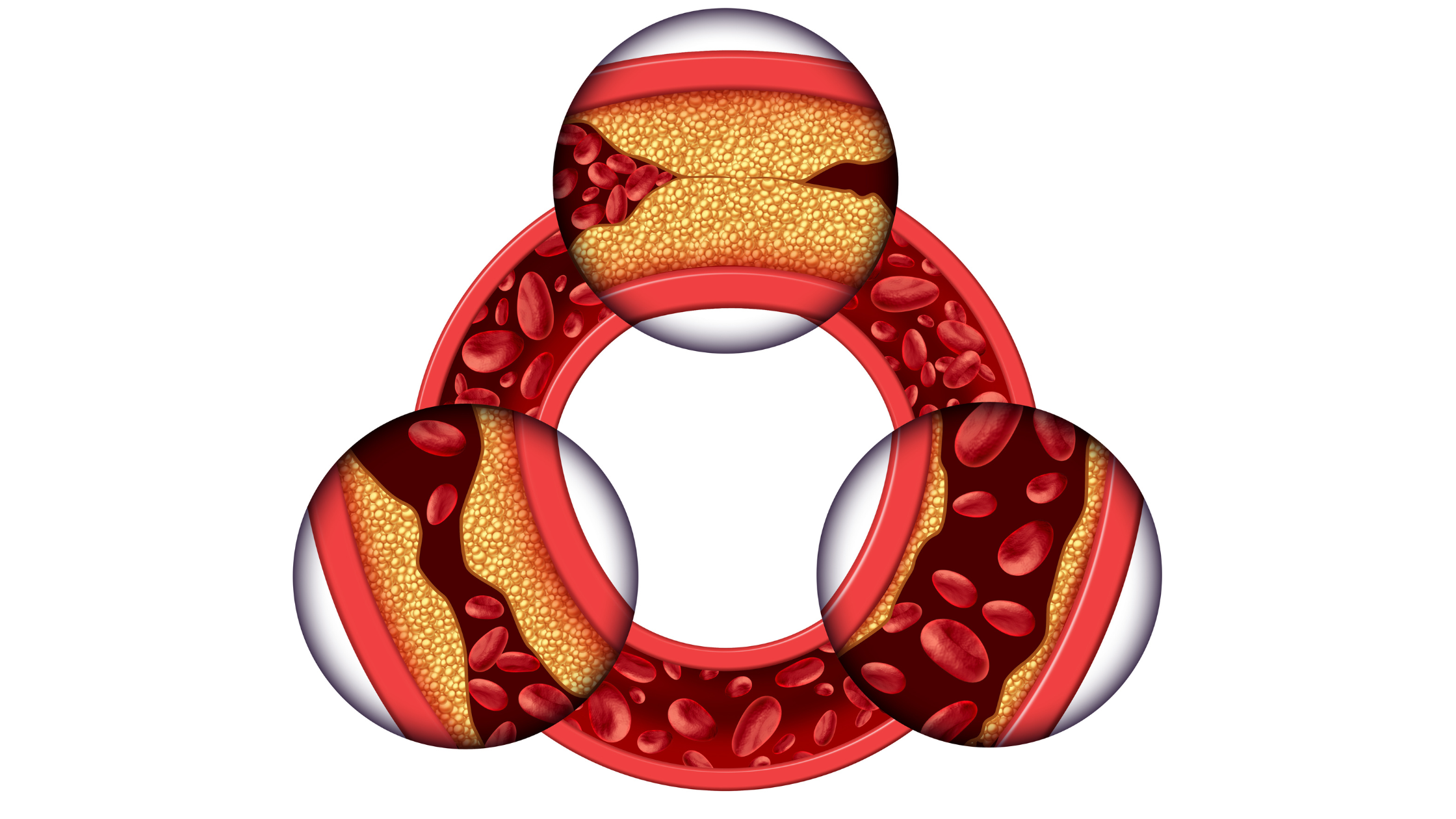 Coronary artery disease 