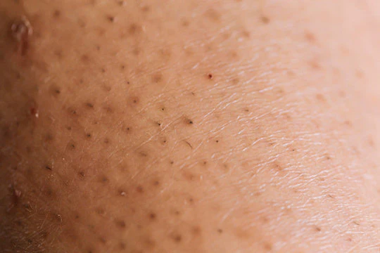 No more ingrown hairs