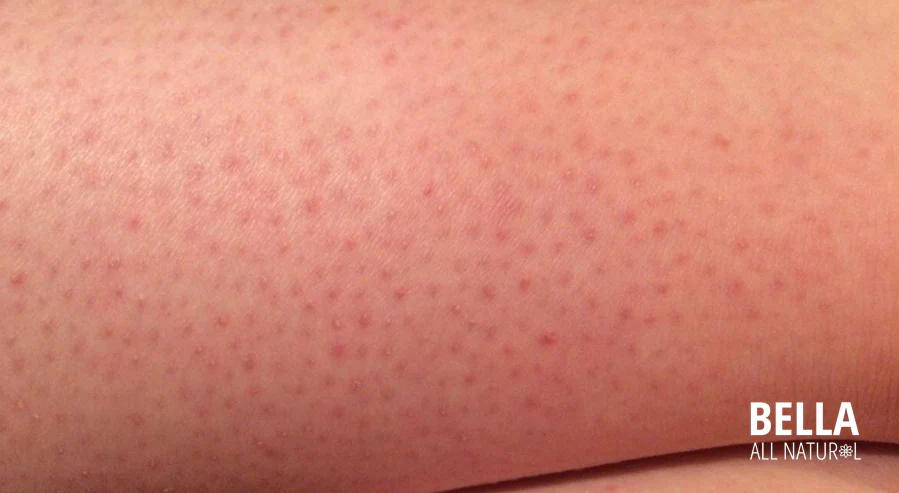 No more razor burns