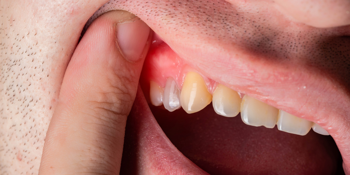 What Causes Gum Recession?