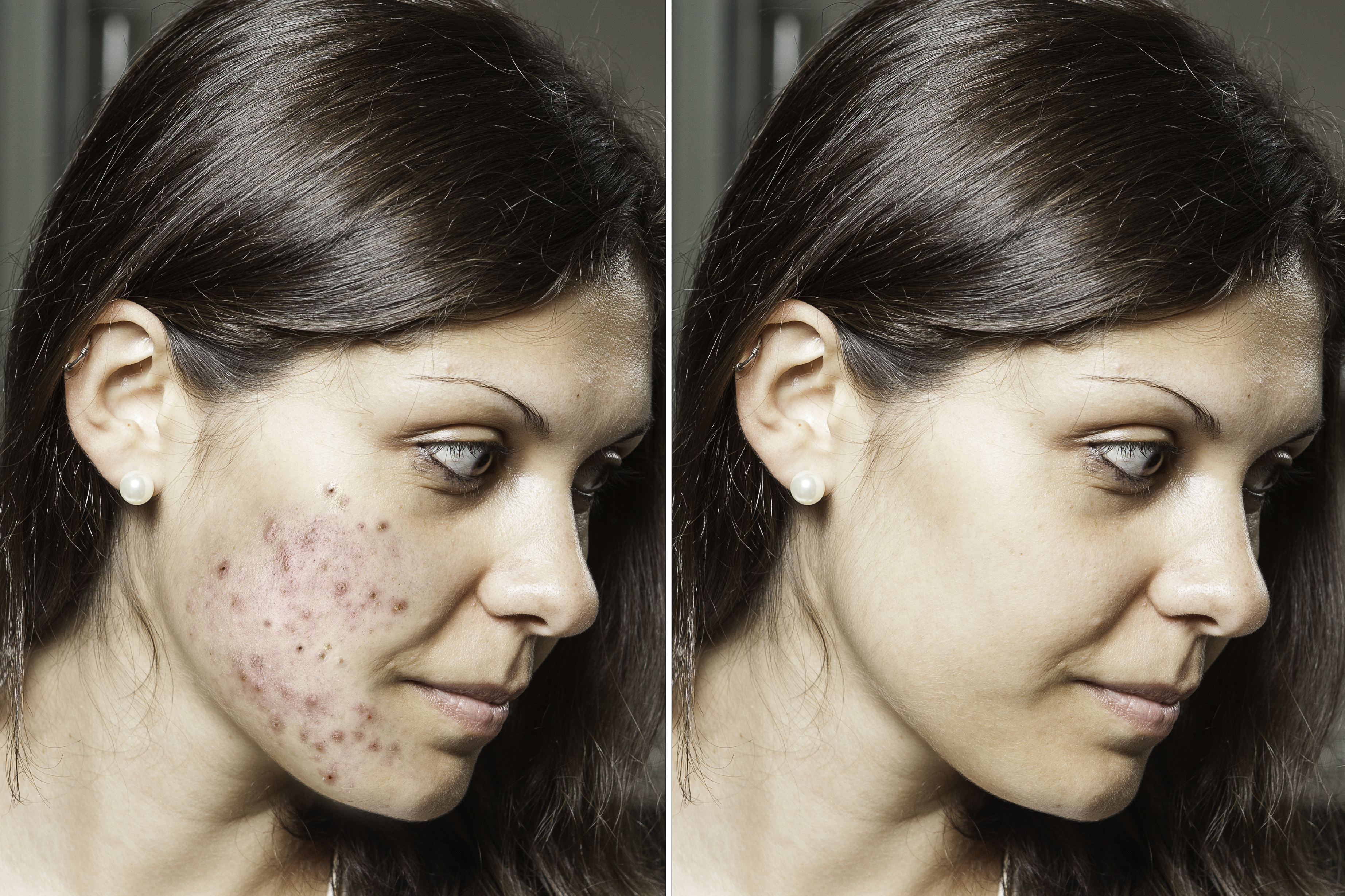 acne scars comparison  img 