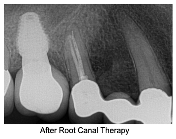 After Root Canal After Root Canal