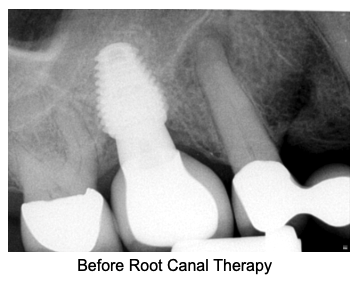 Before Root Canal Before Root Canal
