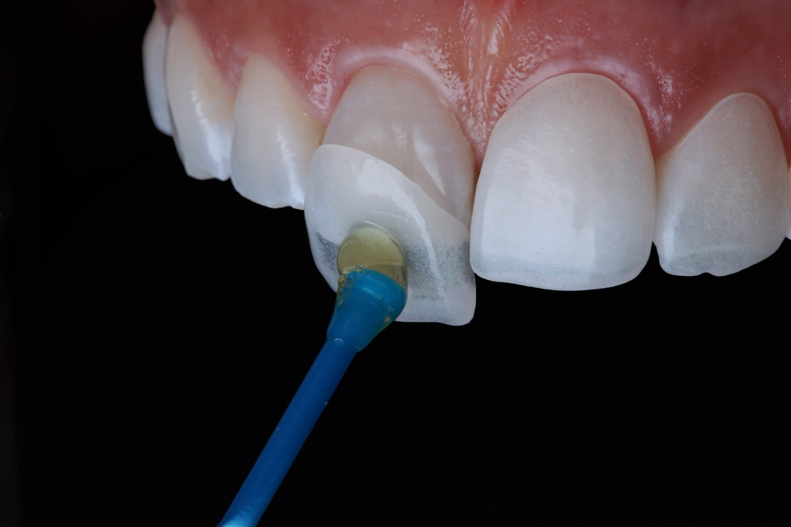 a person getting a veener treatment